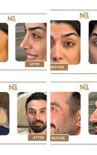 تخفیف ویژه فیلر/ژل/بوتاکس/هایفو