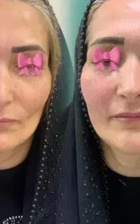 خدمات تخصصی ژل و بوتاکس