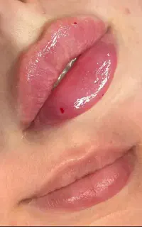 کلینیک زیبایی تزریق ژل و بوتاکس،فیشیال،برداشت خال