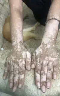 پاکسازی پسوریازیس و پسی