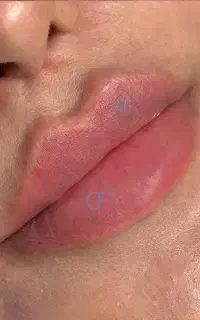 فیلر لب / ژل لب / لب روسی
