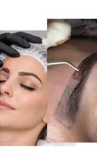 خدمات کا‌شت ابرو به روش جراحی و غیر حراحی