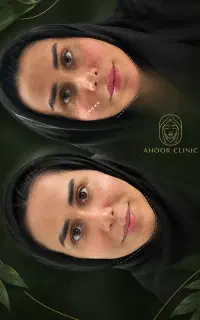 تزریق فیلر توسط پزشک