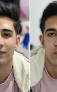 ژل -بوتاکس -فیلر -مزوتراپی ها -پرسینگ ها