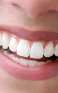عصب کشی دندان های جلویی
