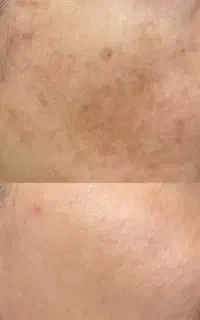 بیوممتیک روشن کننده و رفع کدری و لک در هفت روز