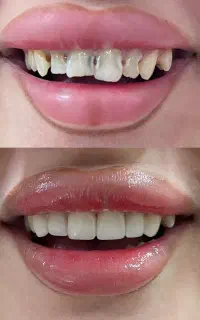 مدل برای کامپوزیت زیبایی