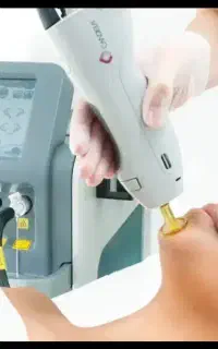 لیزر موهای زائد الکساندرایت کندلا