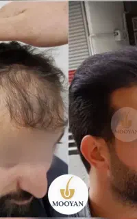 جشنواره‌کاشت‌مو(VIP)۲۴تومن کاشت ابرو۱۴‌(اقساط)