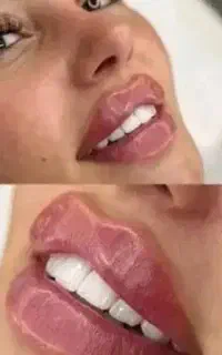 لیزر خانم آقا ژل بوتاکس هایفو لاغری امبدینگ