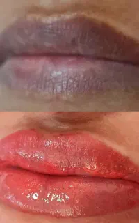 جشنواره تخفیفی کلینیک تخصصی شیدینگ لب ورفع تیرگی