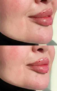 ورکشاپ آموزشی بیوتی تراپی ژل بوتاکس فیلر مزو نخ