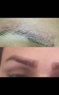 ریموو تاتوهای صورت