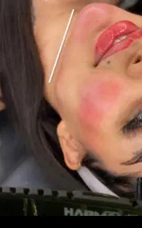 ژل لب گونه چونه خط خنده زاویه فک بوتاکس آنزیم ۴۹۹