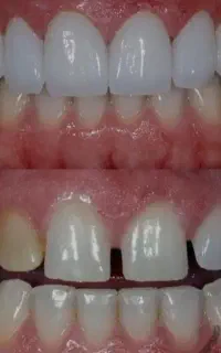 دندانپزشکی لمینت کامپوزیت ایمپلنت  دندان متحرک