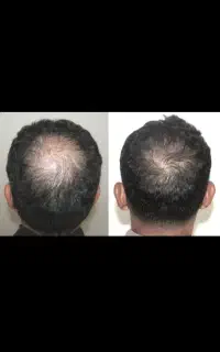درمان پیشرفته مو