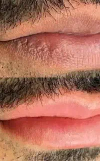 رفع کبودی وتیرگی لب اقایان