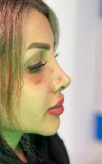 آف جراحی بینی فقط ۲۵تا۳۰ اهواز انجام میشه