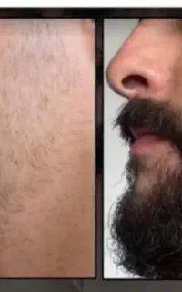 سرم تخصصی رویش ریش وسبیل