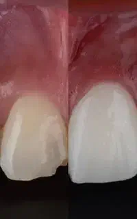 ۶۰ درصد تخفیف کامپوزیت ونیر به مناسبت افتتاحیه