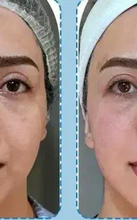 پی ارپی، کربن تراپی،بوتاکس،لیزرسوپرانوتیتانیوم2025
