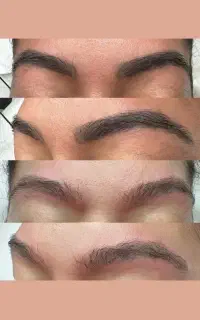 تخفیف ریمو (پاک کردن تتو) ابرو در کیلینیک زیبایی
