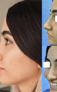 جراحی بینی  با قیمت ویژه جشنواره ۵۰درصد