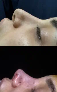 زیبایی چهره با عمل بینی