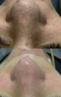 پاکسازی فیشال مراقبت پوستی