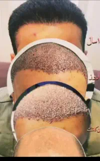 جشنواره ویژه بهاری ژل و بوتاکس وکاشت مو وابرو