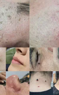 خال برداری-برداشتن خال،نشانه،منگلوله گوشتی