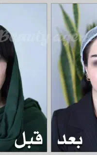 عملMACS LiFT/لیفت صورت/بلفارو/جوانسازی/عمل بینی