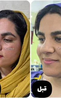 جراحی زیبایی بینی و صورت با بخیه جذبی