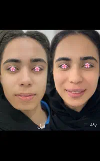 ژل و بوتاکس