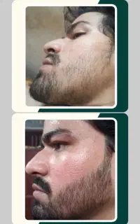 کم پشتی ریش/مو/ابرو