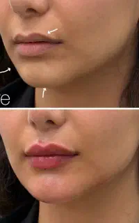 فیلر ژل بوتاکس فیشال کلینیک زیبایی