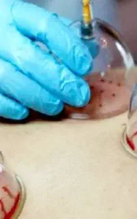 زالو درمانی،حجامت،شکسته بندی و دررفتگی درمنزل