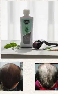 با ریزش و کم پشتی موهات خداحافظی کن