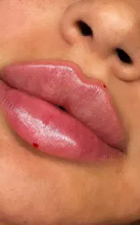 بوتاکس ،جوانساز ،لب روسی ،فول فیس ،فیلر گونه زاویه