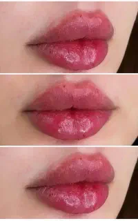 ژل و بوتاکس فیلرلب کانتورینگ مزوژل توسط پزشک۸۹۹