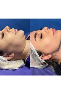 بی نظیرترین سوپرکانتورینگ غبغب با سابقه 8000جراحی
