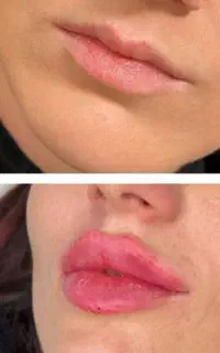 تزریق ژل و بوتاکس برای خانم ها