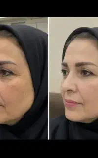 کرم۱۵کاربیوممتیک ضدچروک وروشن سازوکلاژن ساز طبیعی