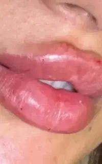 ففیلر للب