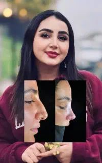 عمل بینی به روش پرزرویشن رینوپلاستی