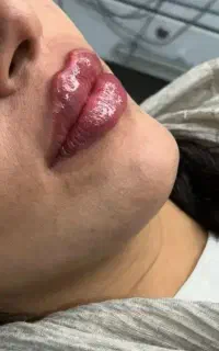 انجام خدمات و آموزش ژل و بوتاکس کل صورت و بدن