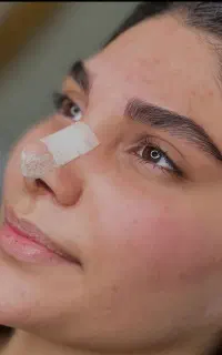 فیبروز و میکروبلیدینگ و شدینگ