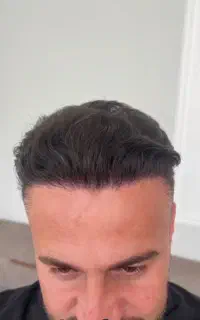 جشنواره کاشت مو و ابرو