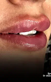 تزریق ژل ،بوتاکس،مزو توسط پزشک با شرایط اقساط