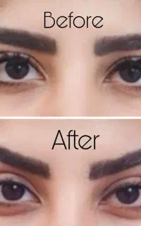 بلفارو،دایرکت ابرو،میدفیس،ساکشن اقساطی